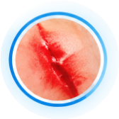 Lacerations & Acute Cuts