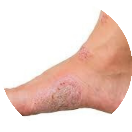 Diabetic Foot Ulcers (DFU)